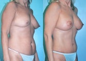 Breast Lift + Augmentation & Tummy tuck