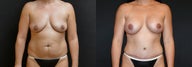Breast Augmentation + Tummy Tuck