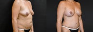 Breast Augmentation + Tummy Tuck