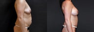 Breast Augmentation + Tummy Tuck