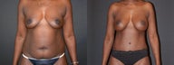 Mommy Makeover