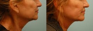Neck Rejuvenation