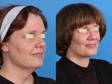 Neck Lift