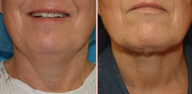 Jawline / Neck Lipo