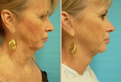 Jawline / Neck Lipo