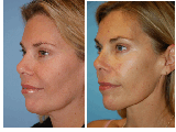 Necklift