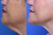 Neck Lift