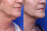 Neck Lift