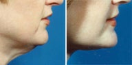 Neck lift