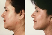 Necklift with Jowl Liposuction