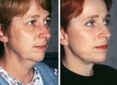 Facelift