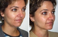 Neck Lift and Chin Implant