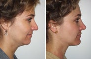 Rhinoplasty, Neck Lift and Chin Implant