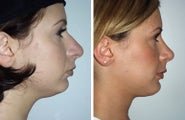 Neck Lift and Chin Implant