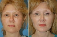 Neck Lift and Chin Implant