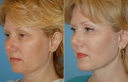 Neck Lift and Chin Implant