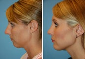 Chin Implant, Rhinoplasty