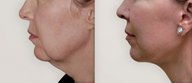 Neck Lift