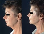 Neck Lift