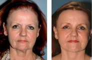 Neck Lift