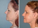 Neck Lift