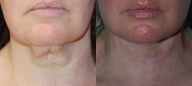 Neck Lift