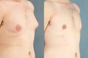 Nipple Areola Reconstruction