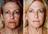 Non-Surgical Face Lift- Exoderm 