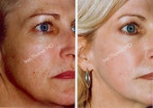 Non-Surgical Face Lift- Exoderm 