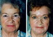 Non-Surgical Face Lift- Exoderm 