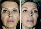 Non-Surgical Face Lift- Exoderm 