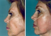 Non-Surgical Face Lift- Exoderm 
