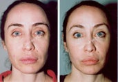 Non-Surgical Face Lift- Exoderm 