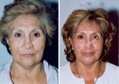 Non-Surgical Face Lift- Exoderm 