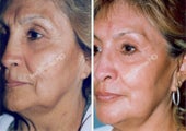Non-Surgical Face Lift- Exoderm 