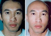 Non-Surgical Face Lift- Exoderm 
