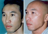 Non-Surgical Face Lift- Exoderm 