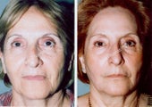 Non-Surgical Face Lift- Exoderm 