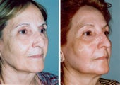Non-Surgical Face Lift- Exoderm 
