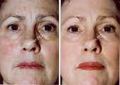Non-Surgical Face Lift- Exoderm 