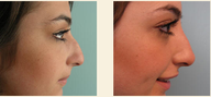 Non Surgical Nose Job