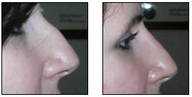 Non Surgical Nose Job