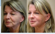 Liquid Facelift with Female