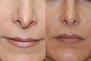 Non-Surgical Rhinoplasty with Silikon-1000 for nostril asymmetry and a pinched tip after previous Rhinoplasty Surgery.