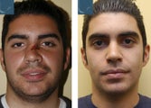 Nasal Reconstruction, Revision Rhinoplasty