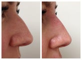 Non-surgical nose job