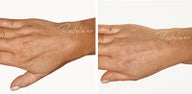 Before and after Restylane Perlane to hands