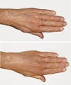 Before and after Restylane Perlane to hands
