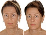 Before and after Restylane Perlane