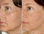 Before and after Restylane Perlane